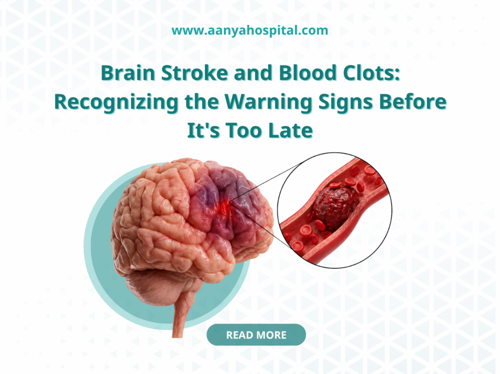 Brain Stroke